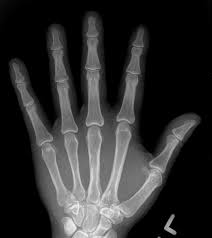 Absolutely heartbreaking for an nba fan such as myself to see such a great player undergo such an injury. What Does Hand Arthritis Look Like On X Rays Raleigh Hand To Shoulder Center Raleigh Hand To Shoulder Center