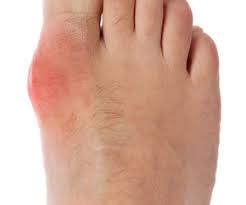 pain in your big toe bunion