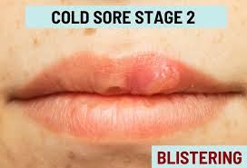 cold sore ses with pictures