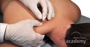 Dry Needling Precise Safe And Effective