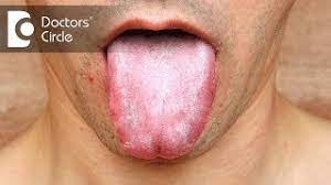 candidiasis to hiv status