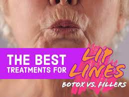 for lip lines botox vs fillers
