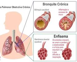 Imagem de Doença pulmonar obstrutiva crônica (DPOC)