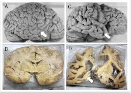 normal brain and alzheimer s disease