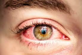 eyelid inflammation in ocular rosacea