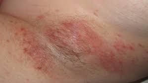 Jock itch (tinea cruris) is a fungal infection that causes a red and itchy rash in warm and moist areas of the body. Common Rashes Found In The Armpits