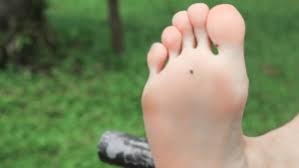 brown spots on feet causes