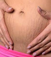 red stretch marks causes treatments