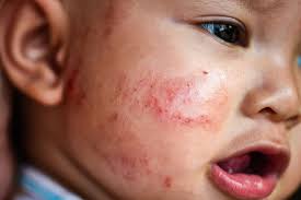 types of baby rashes enrow a