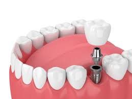 4 types of dental bridges procedure