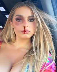 Addison Rae's fans worry after she posts photo with 'black eye & nosebleed'  after backlash over UFC hosting gig | The US Sun
