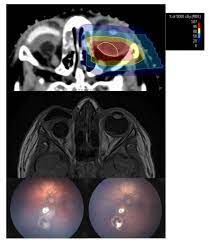 feasibility of proton beam therapy as a