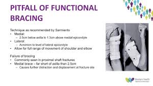 Most centres in north america and europe favor functional bracing. Humeral Shaft Fractures Is Sarmiento S Paper Still Relevant By Dr Dharsh Musiienko Youtube