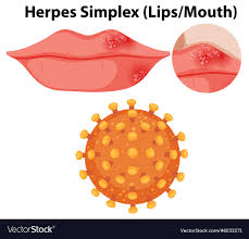 herpes simplex virus lipsmouth royalty