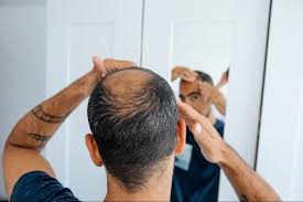 hair loss solutions for men women