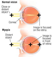 Nearsightedness Myopia Harvard Health