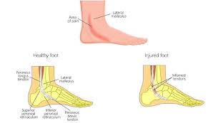 ankle pain from running