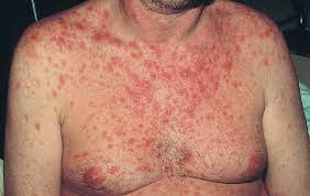 rash ociated with an hiv infection