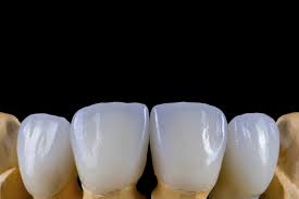 Dental Crown and Bridge Restorations - Nash Dental Lab