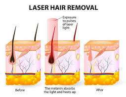 laser hair removal burn injuries