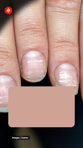 deficiency causes white spots on nails