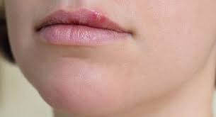 itchy lips causes and prevention