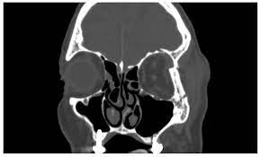 orbital walls fractures