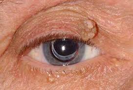 eyelid lesion removal advanced eye