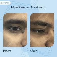 best laser hair removal in bangalore