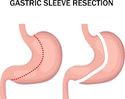 can you chew gum after gastric sleeve