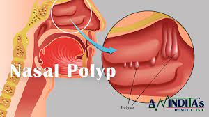 best treatment for nasal polyps using