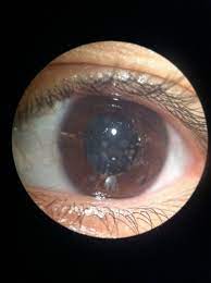 Corneal Stromal Dystrophies Eyewiki
