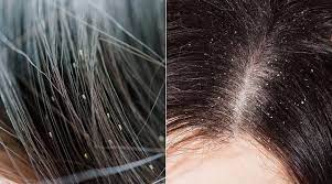 does hair dye kill lice myths facts