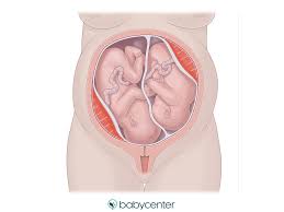 fetal presentation how twins