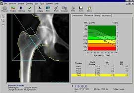 Pin On Bone Density Nutrition And Exercise