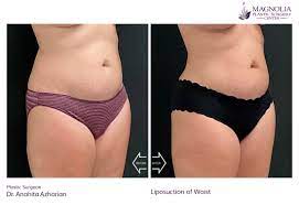 fat removal body contouring