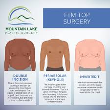 female to male top surgery vermont