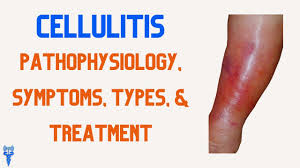 cellulitis pathophysiology types