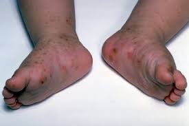 Hand, foot, and mouth disease. Rashes In Babies And Children Nhs