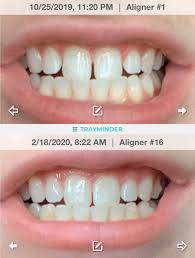 An incisal gap (large or small) is when there is a gap between the incisal edge of the tooth and the aligner. Tray 16 26 Almost There Do You Always Need A Frenectomy To Keep Gap In Front Teeth Closed Imgur