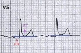 Premature atrial/ventricular beats concave upward st segment elevation in all leads st depression in avr or v1 t waves flattenas st elevation returns to base line no reciprocal. Pericarditis Ecg Changes Litfl Ecg Library Diagnosis