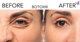 Check spelling or type a new query. Botox For Fine Lines Wrinkles Derma Health Institute
