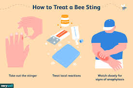 bee sting treatment minor and severe