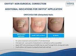 onyfix ingrown toenail treatment