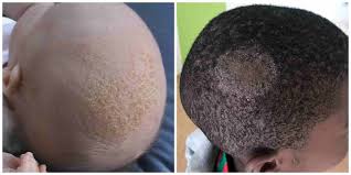 at what age does hair loss stop