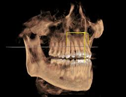 cone beam 3d imaging mill point dental