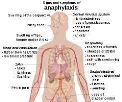 Anaphylaxis is a rare but severe allergic reaction. Anaphylaxis Simple English Wikipedia The Free Encyclopedia