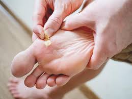 warts on the soles of your feet