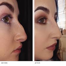 After explaining her botox, nikkie gets onto fillers and unlike kylie jenner she is completely open about her lip injections simply saying, lips, duh, before pointing to her nose she says botox here for the bunny lines, before pointing to the corners of her mouth and explaining that injecting botox there. Non Surgical Nose Reshaping The Laser And Skin Clinic