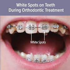 Home health tips how to get white teeth naturally? How To Reduce Tooth White Spots While Wearing Braces Mvp Smiles